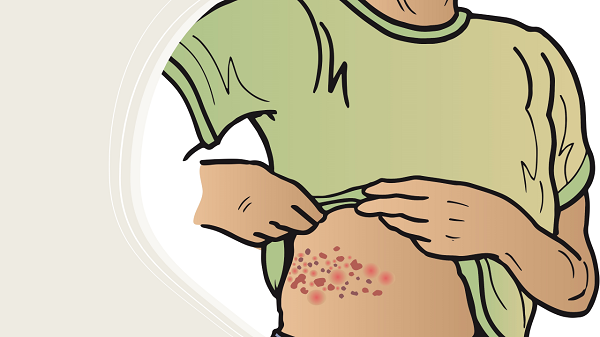 Illustration of a shingles rash.